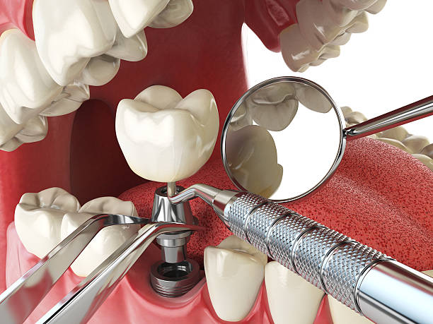 Best Emergency Treatment for Dental Infections or Abscesses in Priest River, ID